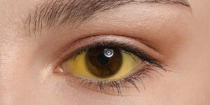 Liver Problem Symptoms in Females